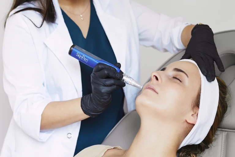 Co daje mezoterapia mikroigłowa? Poznaj SkinPen